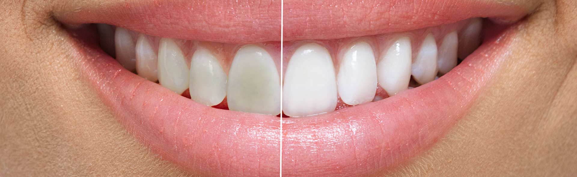 Northland Smiles | NW Calgary Dentist | Teeth Whitening
